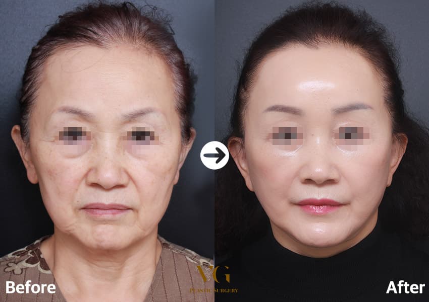 Face Lift