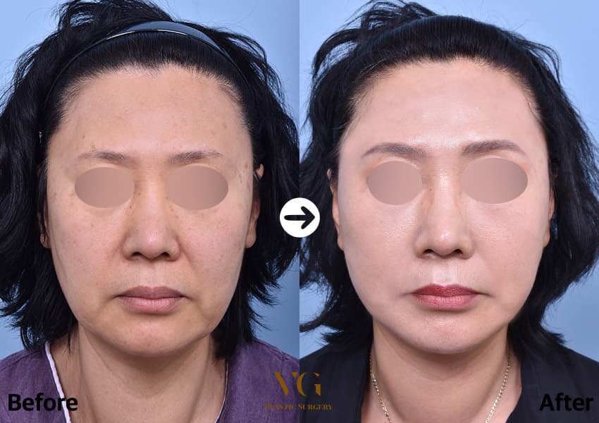Face Lift