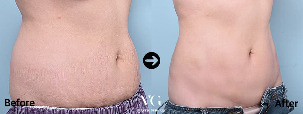 Body contouring before and after — case 446
