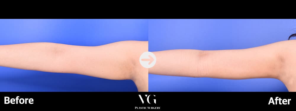 Body contouring before and after — case 591