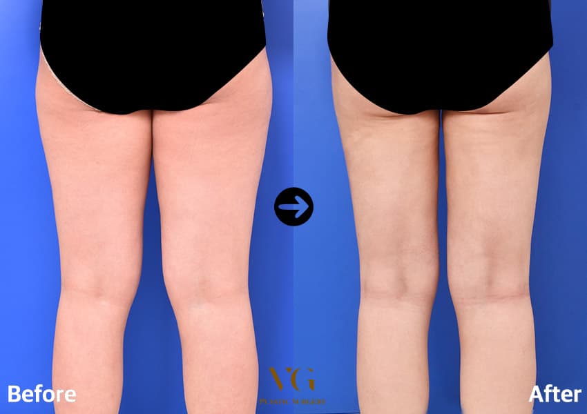 Body contouring before and after — case 592