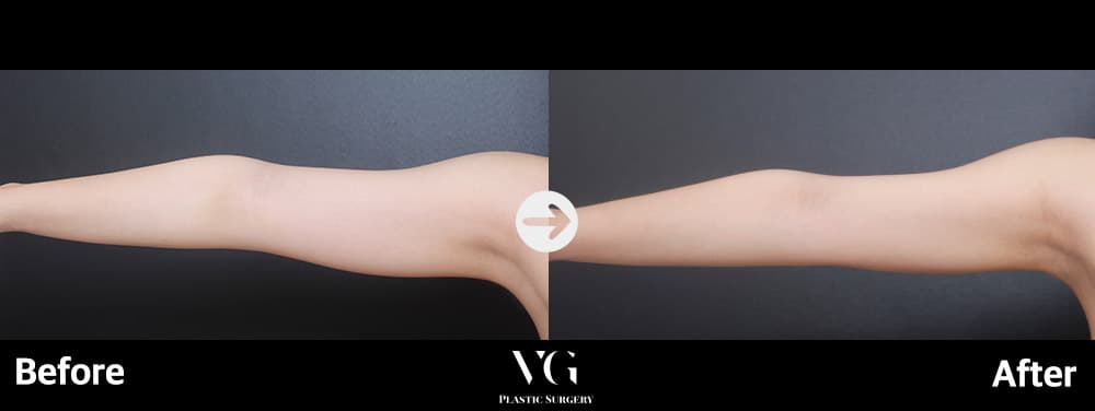 Body contouring before and after — case 688
