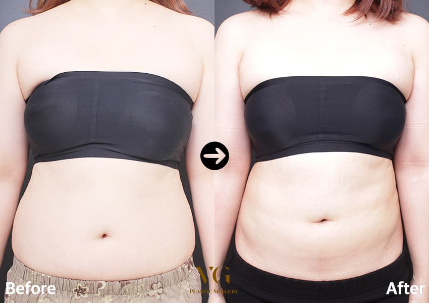 Body contouring before and after — case 738