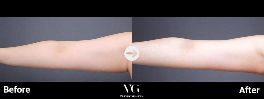 Body contouring before and after — case 740