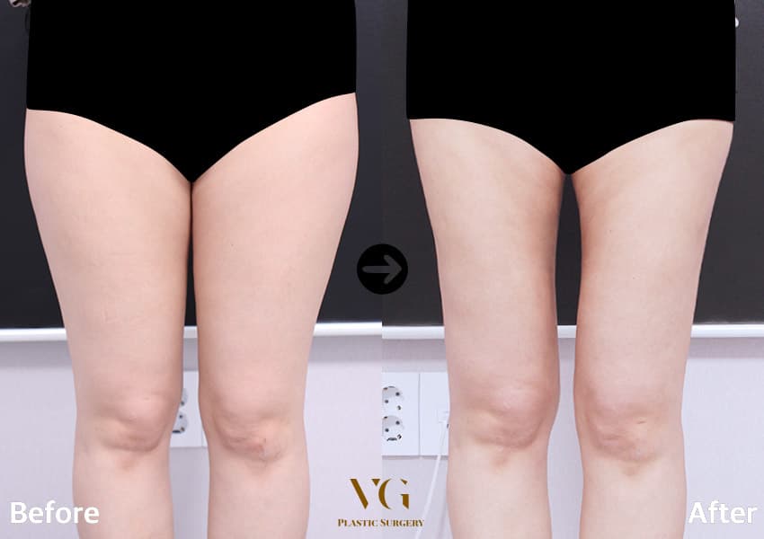 Body contouring before and after — case 772