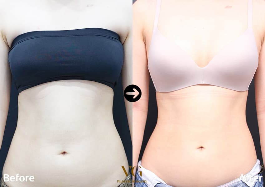 Abdominal Liposuction
