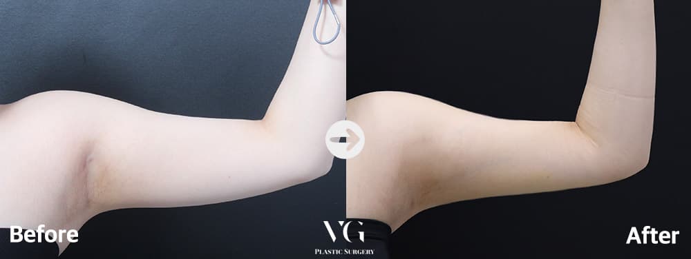 Arm Liposuction