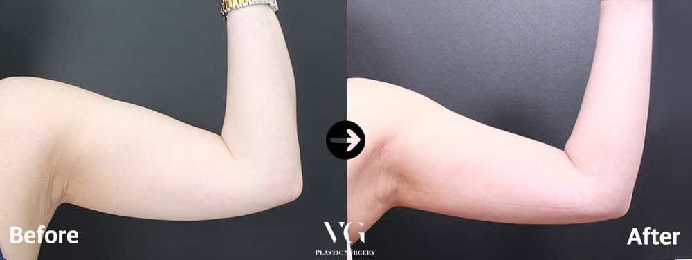 Arm Liposuction