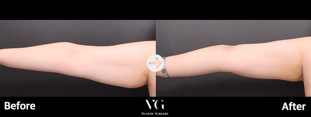 Arm Liposuction