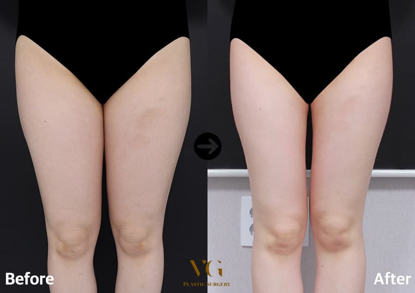 Thigh Liposuction