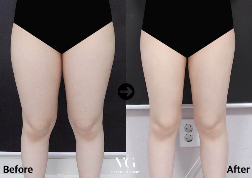 Thigh Liposuction
