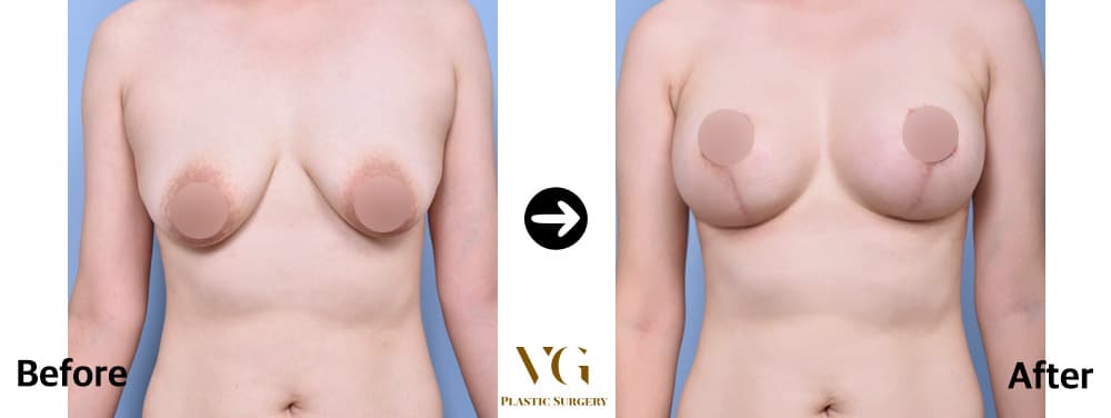 Breast Lift + Breast Augmentation + Accessory Breast Removal