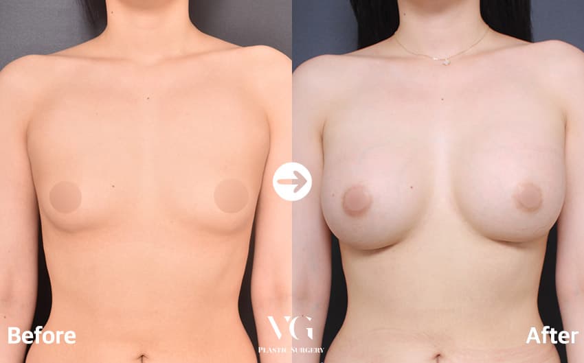 Breast Augmentation