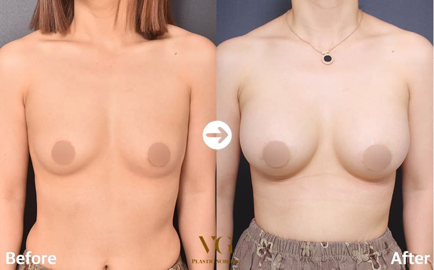 Breast Augmentation