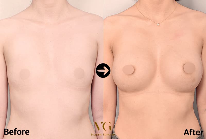 Breast Augmentation