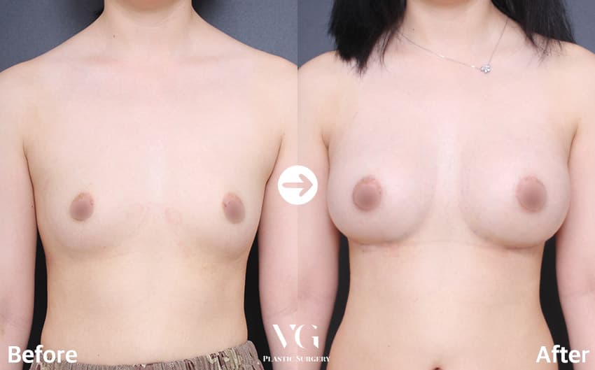 Breast Augmentation