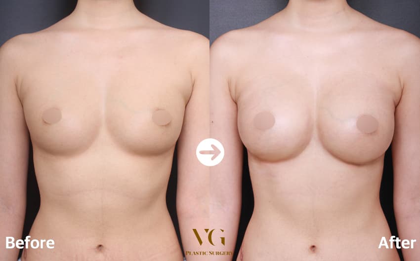 Breast before and after — drag to compare