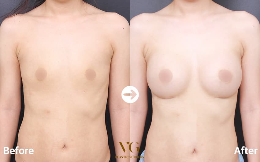Breast before and after — drag to compare