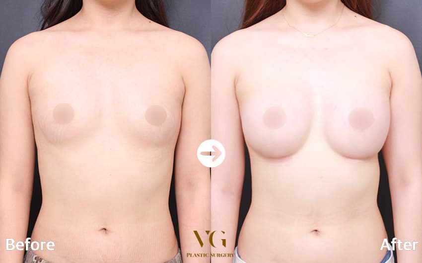 Breast before and after — drag to compare