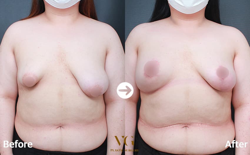 Breast before and after — drag to compare