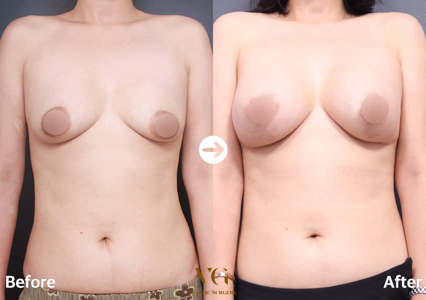 Breast Augmentation + Breast Lift