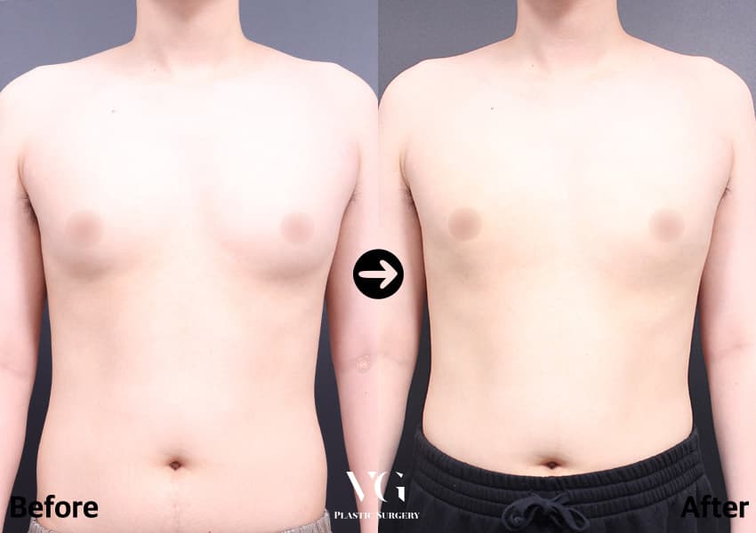 Gynecomastia Surgery