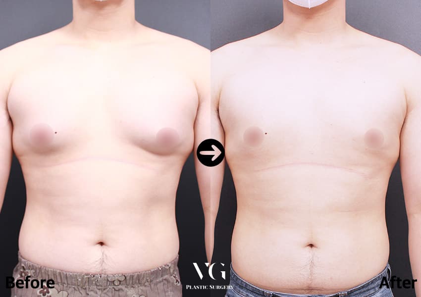 Gynecomastia Surgery