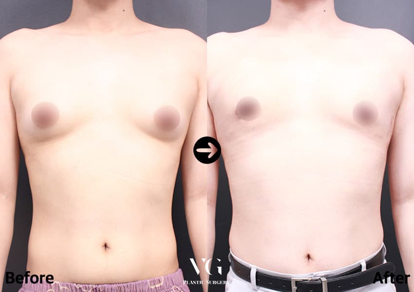 Gynecomastia Surgery