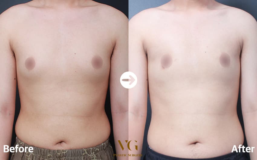Breast before and after — drag to compare
