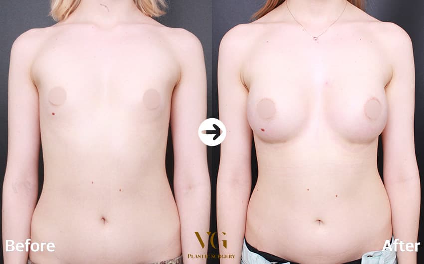 Breast before and after — drag to compare
