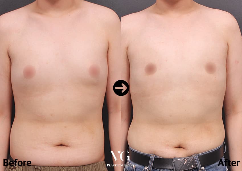 Gynecomastia Surgery
