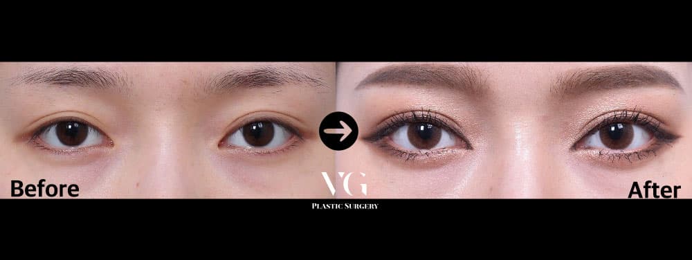 Before and after Natural-adhesion double eyelid with ptosis correction — drag to compare