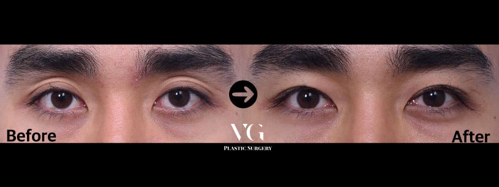 Before and after Incisional double eyelid — drag to compare