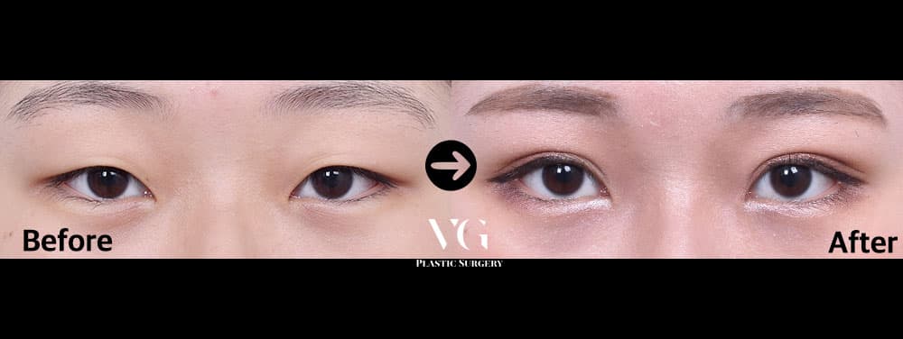 Before and after Incisional ptosis correction — drag to compare
