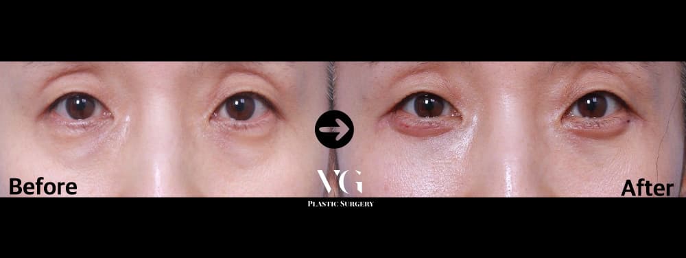 Before and after Lower blepharoplasty — drag to compare