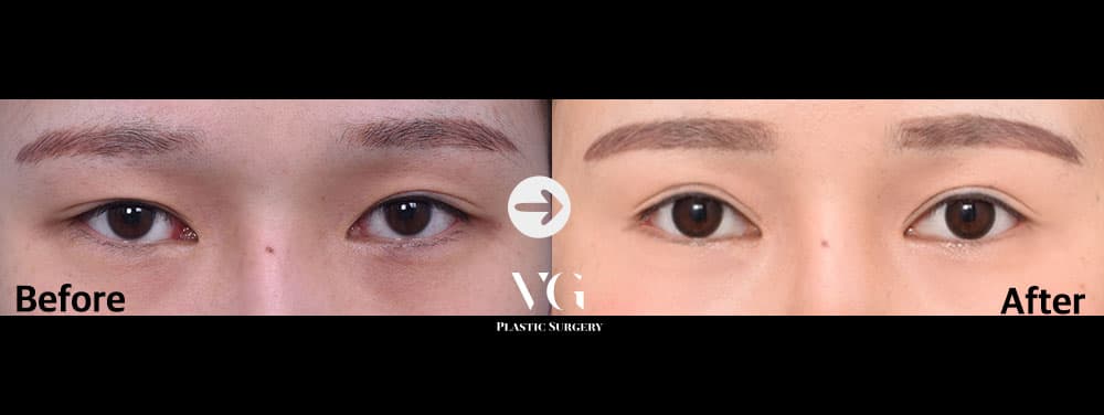 Before and after Eyelid revision — incisional fold and dual epicanthoplasty — drag to compare