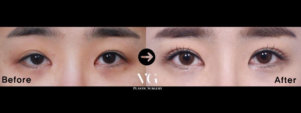 Eye surgery before and after — case 467