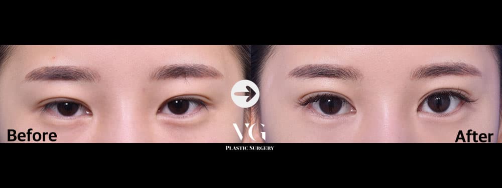 Before and after Eyelid revision — natural-adhesion fold — drag to compare