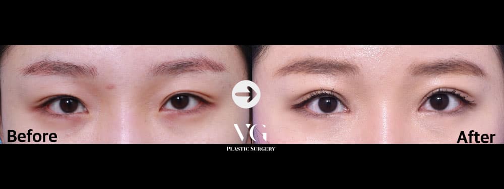 Natural-Adhesion Double Eyelid + Epicanthoplasty (Inner Corner) + Lower Canthoplasty +1