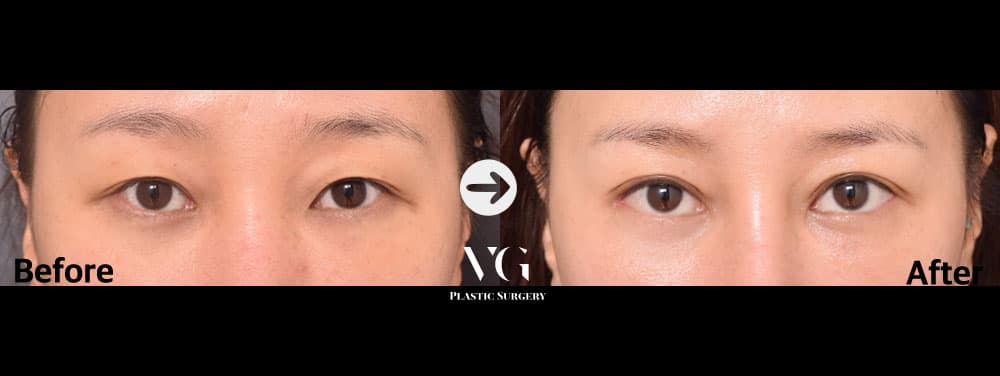 Natural-Adhesion Double Eyelid + Lateral Canthoplasty (Outer Corner) + Lower Canthoplasty