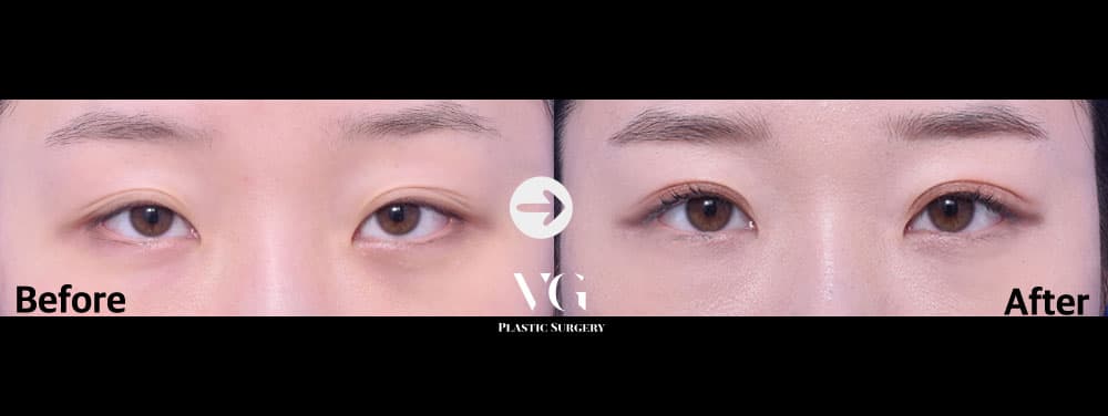 Natural-Adhesion Double Eyelid + Non-Incisional Ptosis Correction