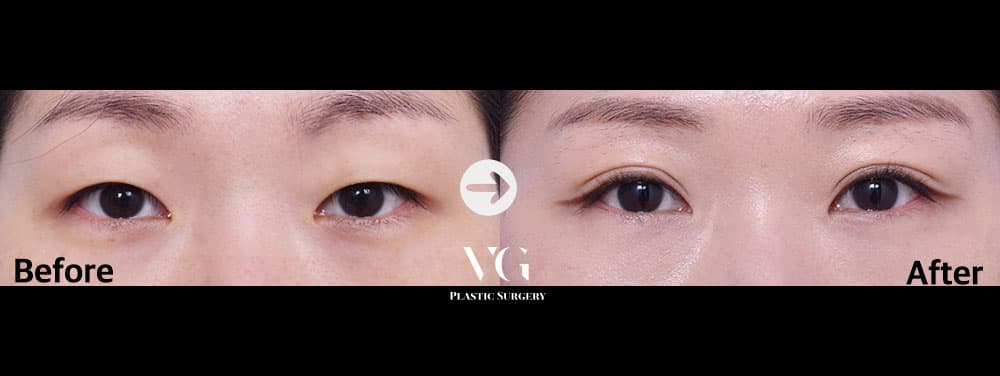 Natural-Adhesion Double Eyelid + Non-Incisional Ptosis Correction