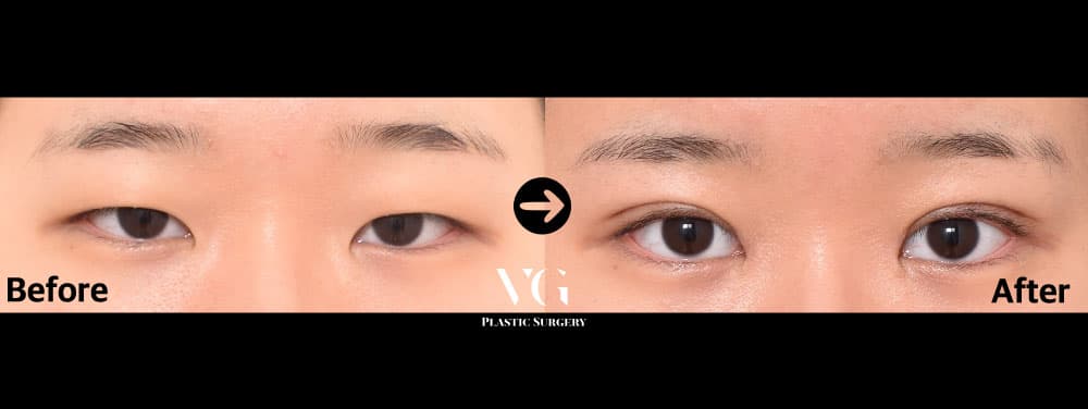 Epicanthoplasty (Inner Corner) + Natural-Adhesion Double Eyelid