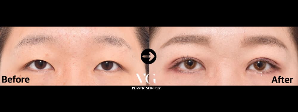 Epicanthoplasty (Inner Corner) + Non-Incisional Ptosis Correction + Natural-Adhesion Double Eyelid
