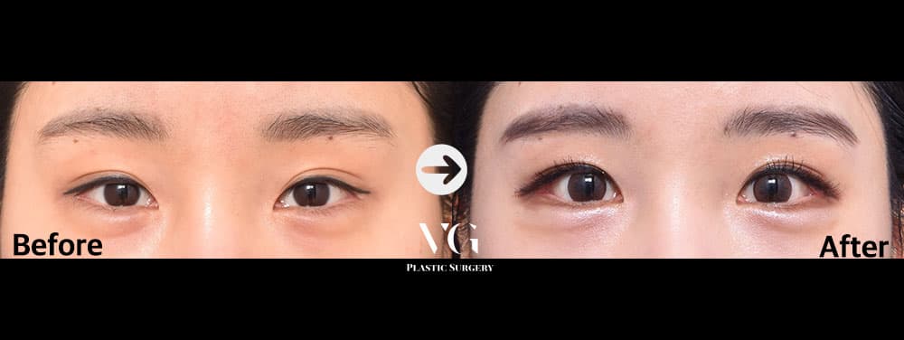 Eye Revision Surgery + Lateral Canthoplasty (Outer Corner) + Lower Canthoplasty