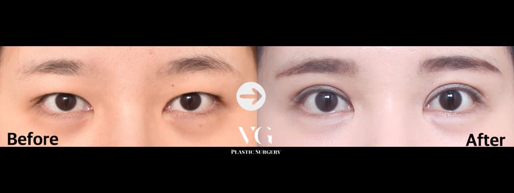 Eye Revision Surgery + Incisional Double Eyelid + Incisional Ptosis Correction