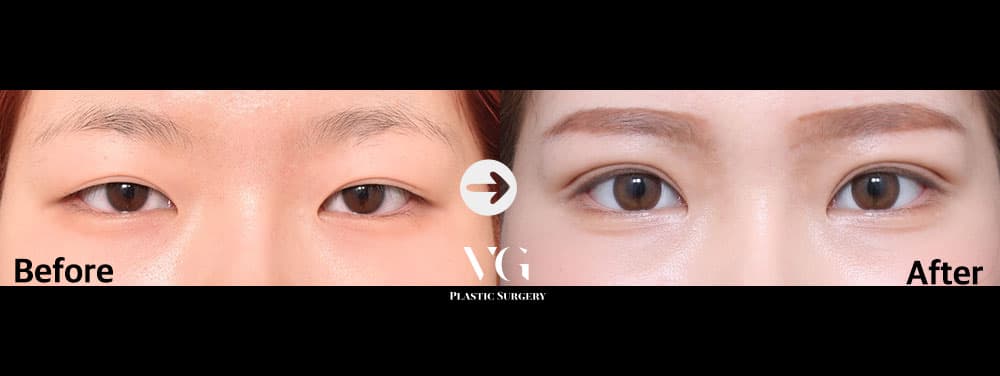 Eye Revision Surgery + Incisional Double Eyelid + Incisional Ptosis Correction