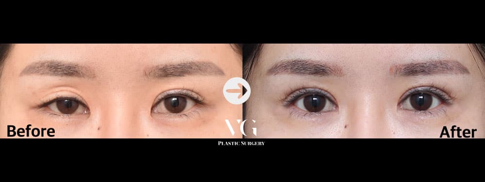 Eye Revision Surgery + Incisional Double Eyelid + Incisional Ptosis Correction +2