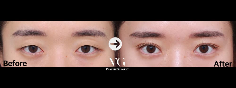 Natural-Adhesion Double Eyelid + Non-Incisional Ptosis Correction
