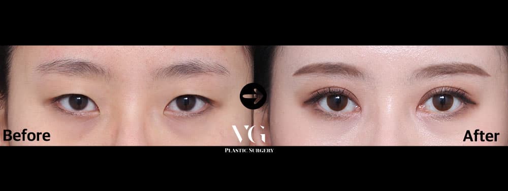 Natural-Adhesion Double Eyelid + Epicanthoplasty (Inner Corner)